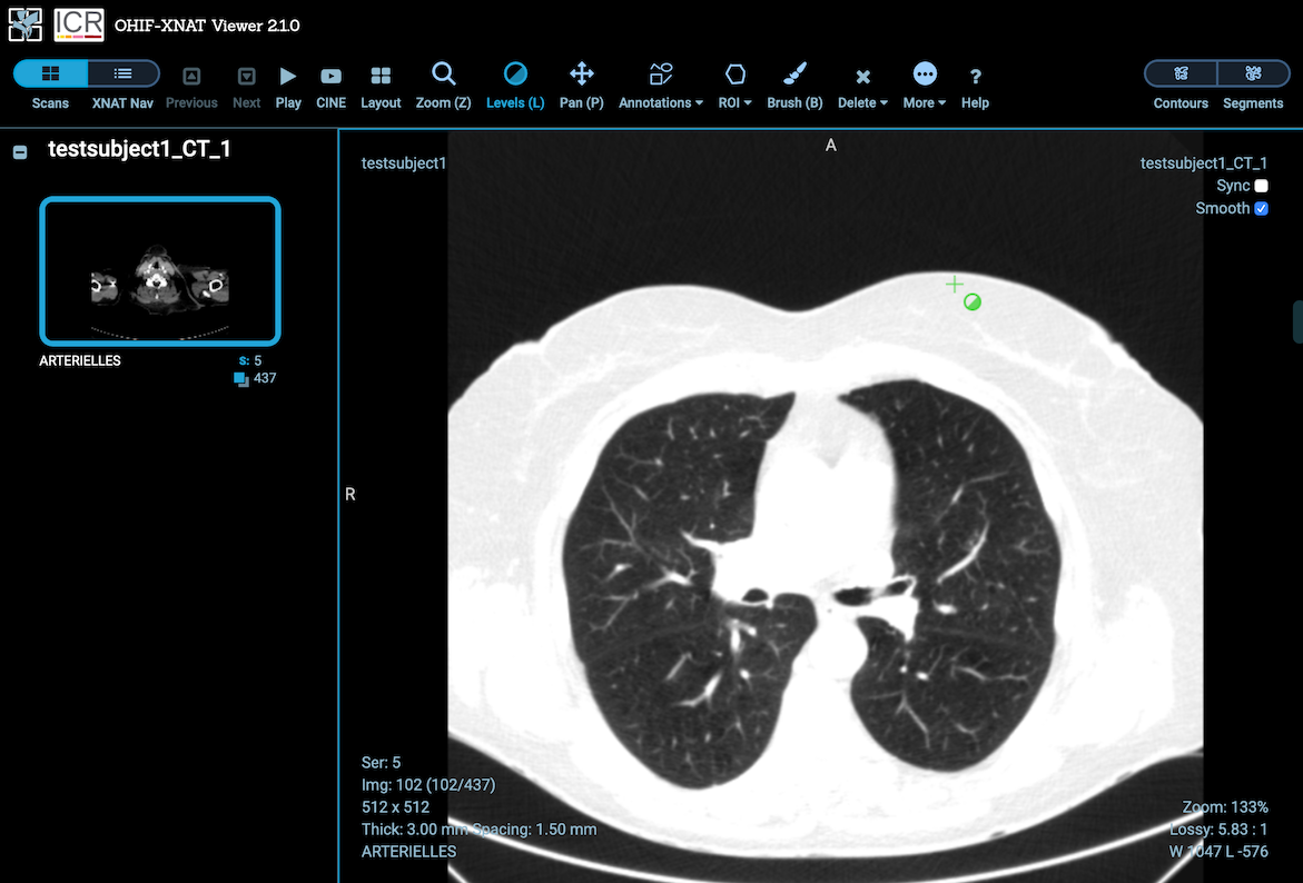 OHIF Viewer